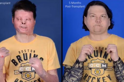 New Jersey man’s double-hand, face transplant is world’s first successful attempt