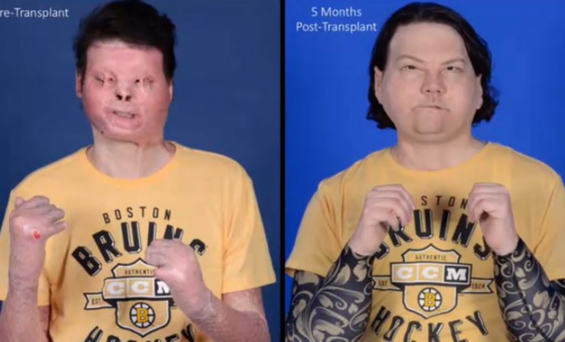 New Jersey man’s double-hand, face transplant is world’s first successful attempt