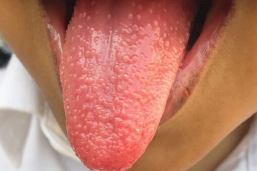 Girl develops ‘strawberry tongue’ during bout with strep throat
