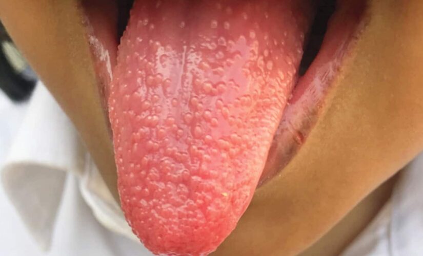 Girl develops ‘strawberry tongue’ during bout with strep throat