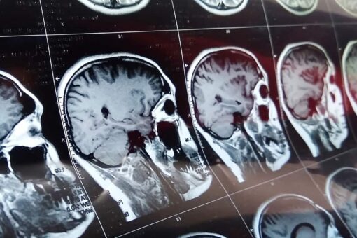 Mysterious brain disease ‘cluster’ under investigation in Canada