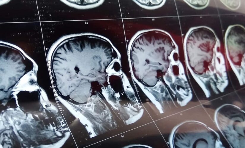 Mysterious brain disease ‘cluster’ under investigation in Canada