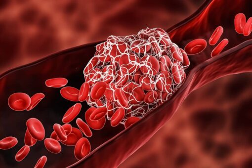 Who is at risk for developing blood clots?