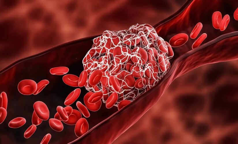 Who is at risk for developing blood clots?
