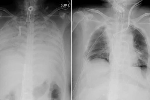 COVID-19 patient receives lung transplant from living donors