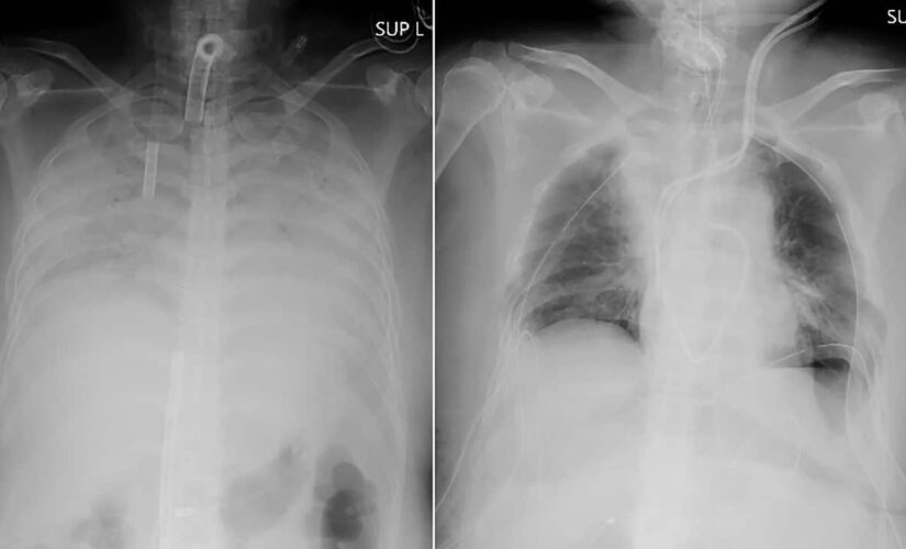 COVID-19 patient receives lung transplant from living donors