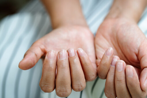 What are so-called COVID nails?