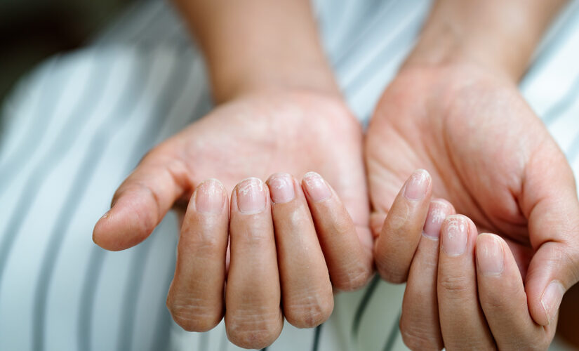 What are so-called COVID nails?