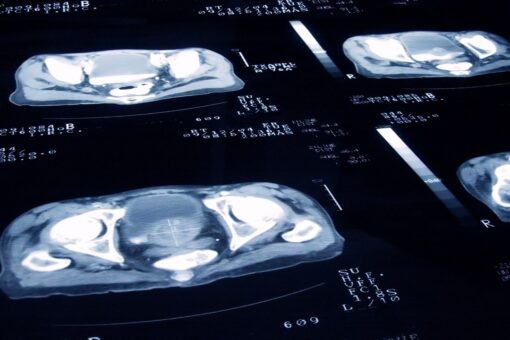 FDA approves new prostate cancer imaging tool, company says