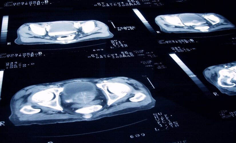 FDA approves new prostate cancer imaging tool, company says