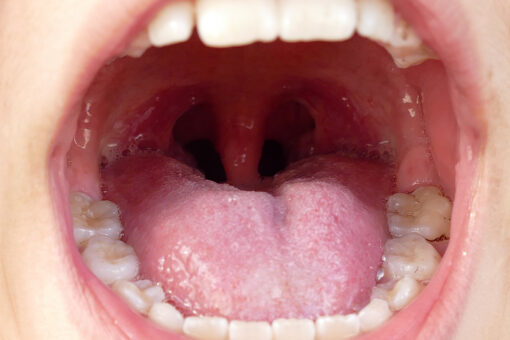Australian woman wakes up with Irish accent after throat surgery