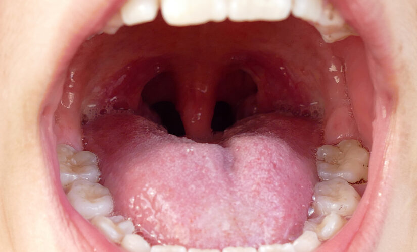 Australian woman wakes up with Irish accent after throat surgery