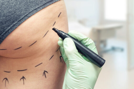 Doctors link woman’s butt fillers to sepsis diagnosis 14 months after procedure