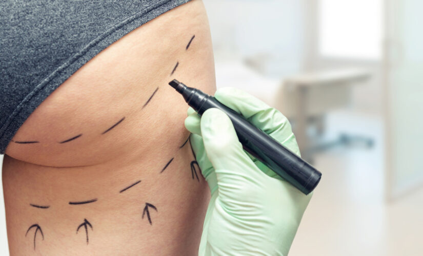 Doctors link woman’s butt fillers to sepsis diagnosis 14 months after procedure