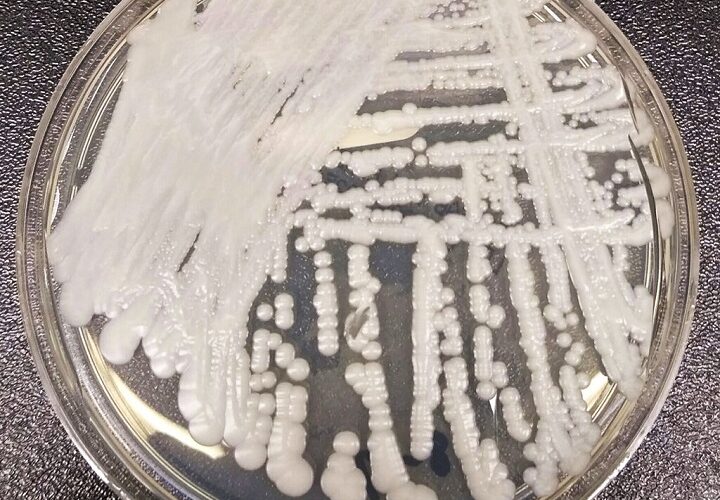 ‘Superbug’ fungus spread in two cities, health officials say