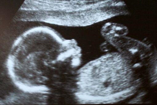 Baby girl born with twin inside stomach in extreme medical rarity: report