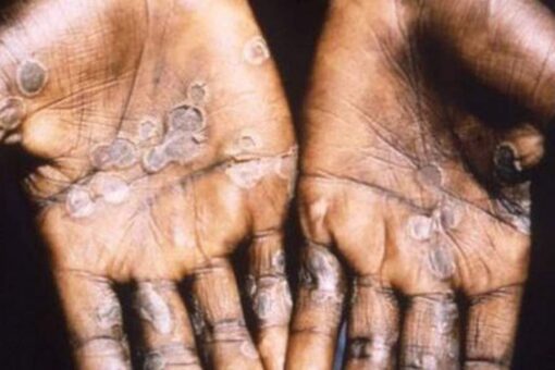 Monkeypox in US: CDC monitoring 200 people in 27 states, other countries
