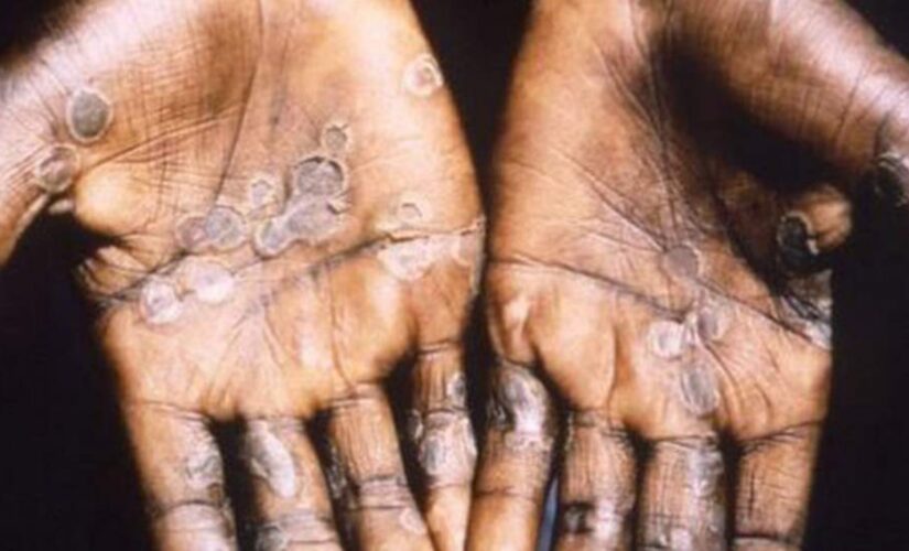 Monkeypox in US: CDC monitoring 200 people in 27 states, other countries