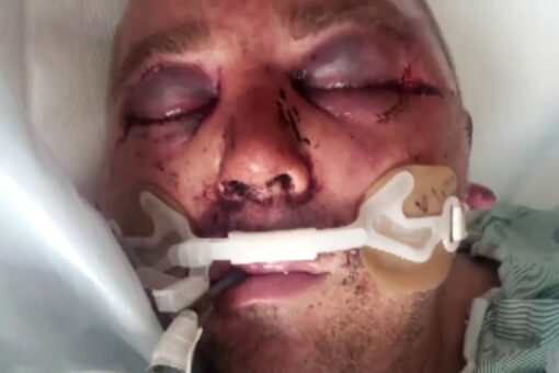 Florida man brutally beaten, put in a coma after asking neighbors to lower music