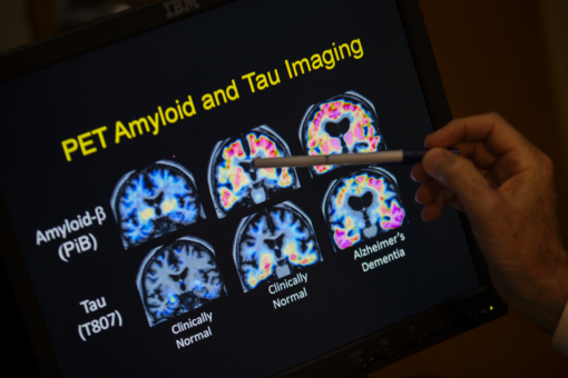 Antibody drug cuts moderate Alzheimer’s decline, Swiss biotech cautions over results