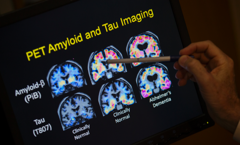 Antibody drug cuts moderate Alzheimer’s decline, Swiss biotech cautions over results