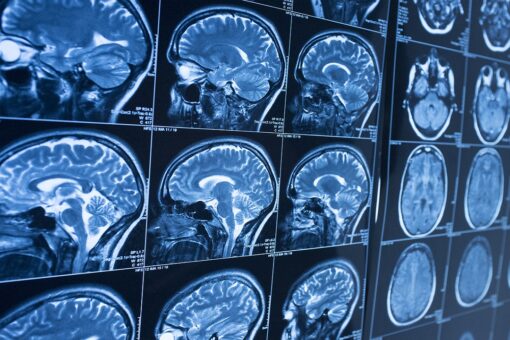 Babies born during COVID-19 pandemic tied with lower IQ, study suggests