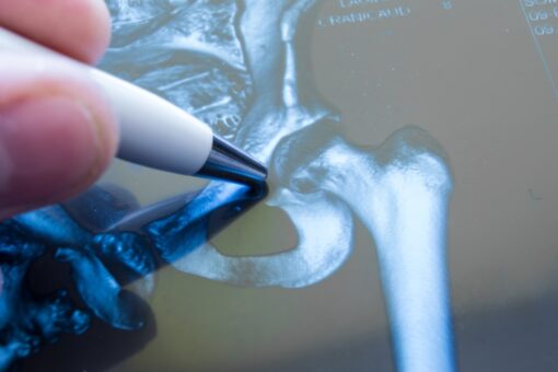 Osteoporotic fractures pose serious harm to men, too: study
