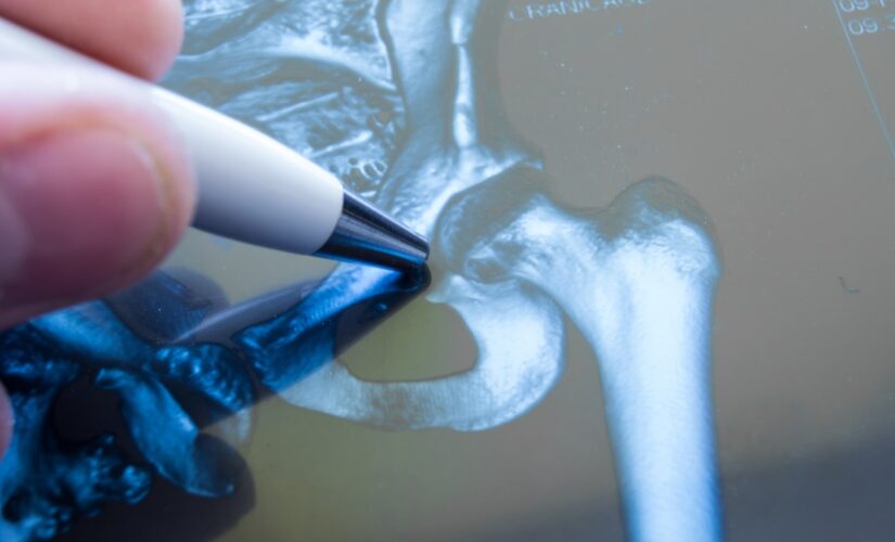 Osteoporotic fractures pose serious harm to men, too: study