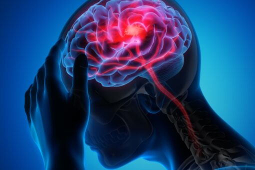 Stroke risk: What to know