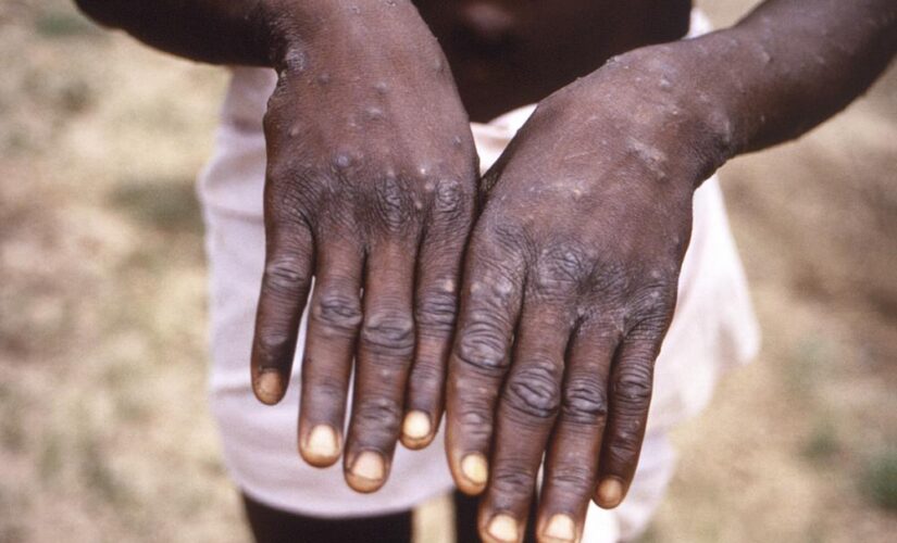 Monkeypox presents moderate risk to global public health, WHO says