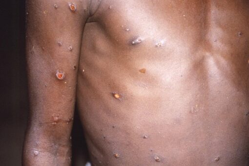 WHO: Nearly 200 cases of monkeypox virus across more than 20 countries