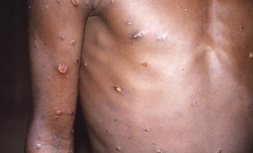 WHO: Nearly 200 cases of monkeypox virus across more than 20 countries