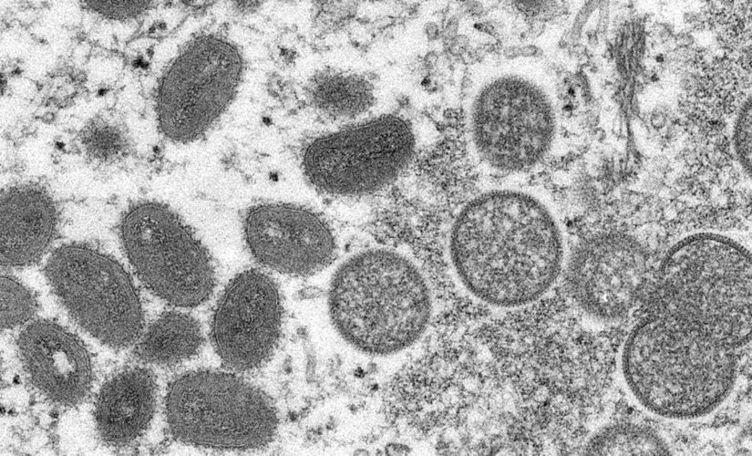 Monkeypox virus case ‘highly likely’ found in Finland