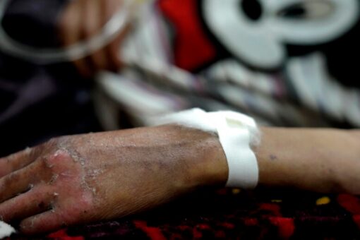 UN: More than 1M children in Afghanistan could face severe malnutrition