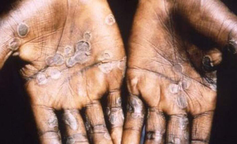 UK confirms more cases of monkeypox