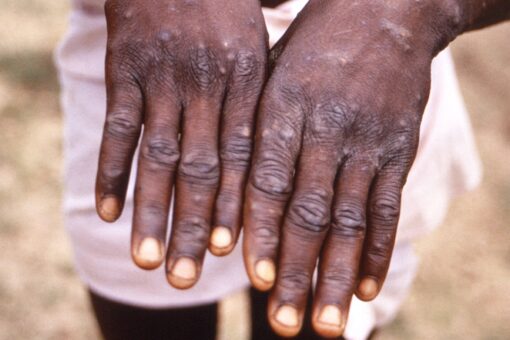 Monkeypox: CDC investigating first US case of the year as growing clusters emerge globally outside Africa