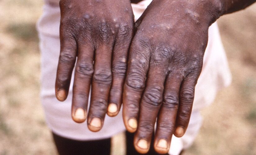 Monkeypox: CDC investigating first US case of the year as growing clusters emerge globally outside Africa