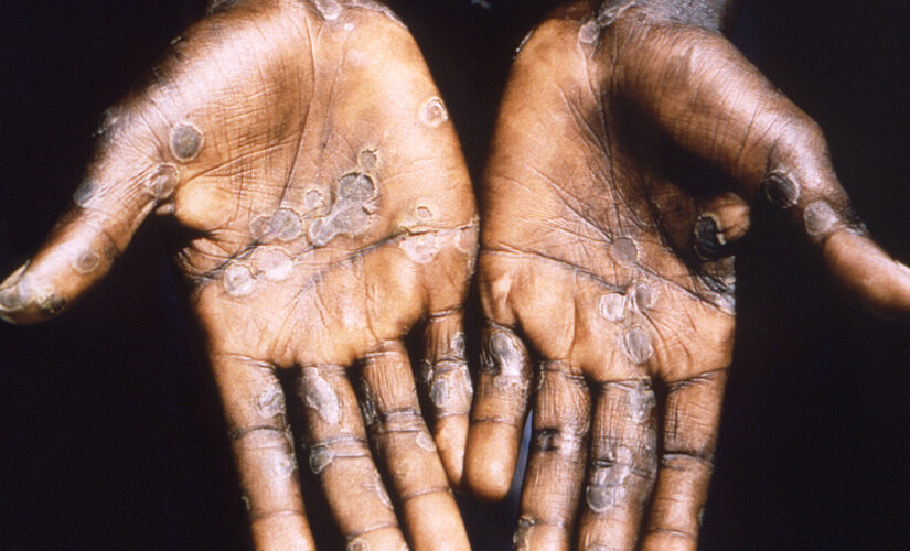 US monkeypox cases climb, another reported in Colorado