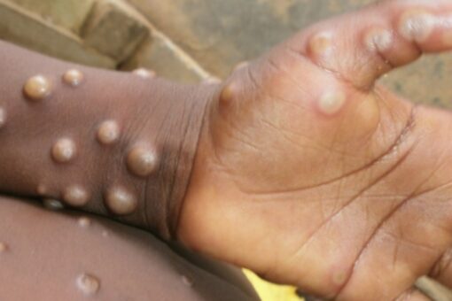 US officials find 2 monkeypox strains