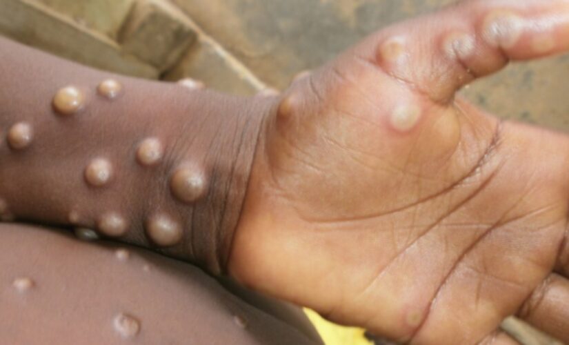 US officials find 2 monkeypox strains