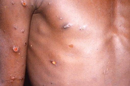 Monkeypox cases may have been spreading undetected in US, Europe for years