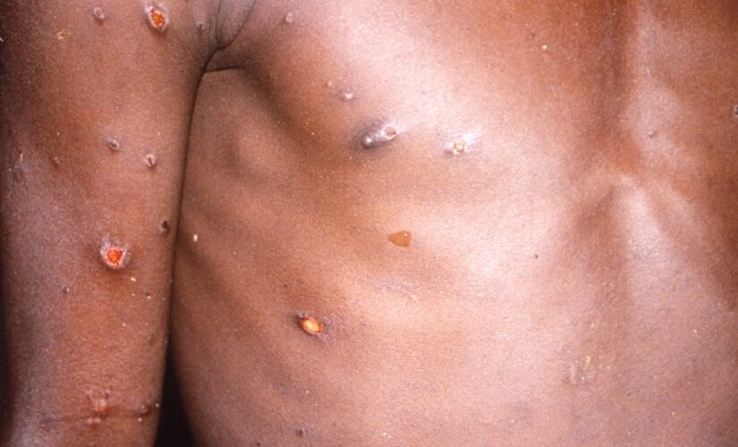 Monkeypox cases may have been spreading undetected in US, Europe for years