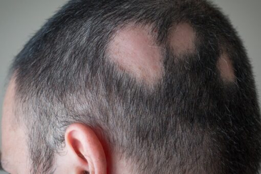 Drug to treat alopecia approved by FDA