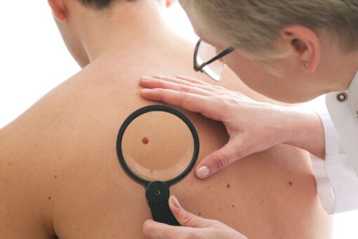 Men’s skin cancer deaths are higher than women’s: New analysis