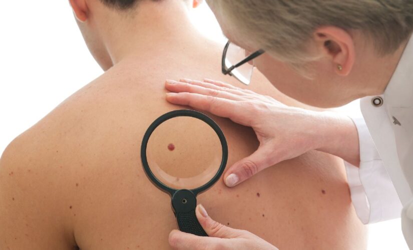 Men’s skin cancer deaths are higher than women’s: New analysis