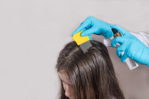 Kids with head lice don’t need to leave school: report