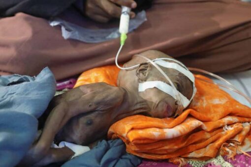 Child malnutrition ravages Central Somalia with nation on brink of famine