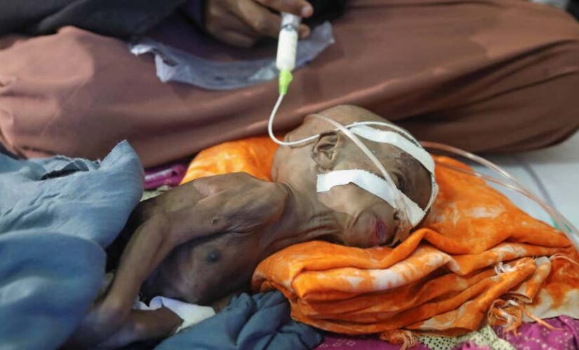 Child malnutrition ravages Central Somalia with nation on brink of famine