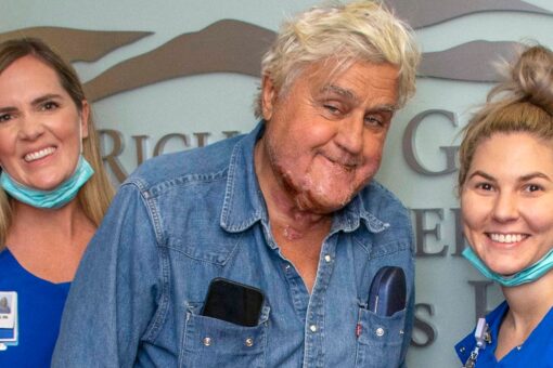 Jay Leno reveals burns from fire, released from hospital
