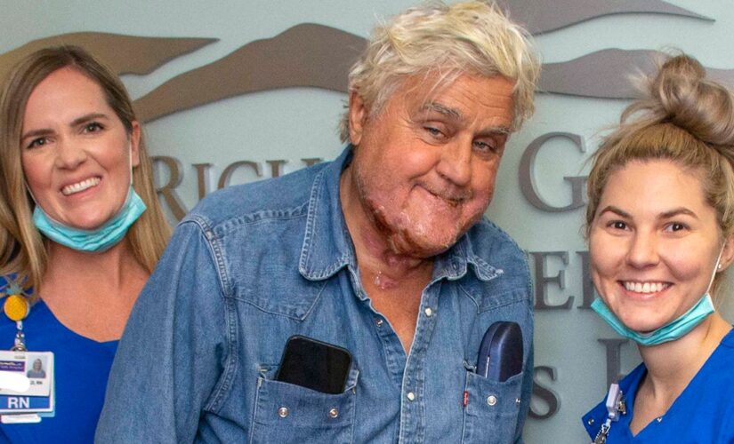 Jay Leno reveals burns from fire, released from hospital